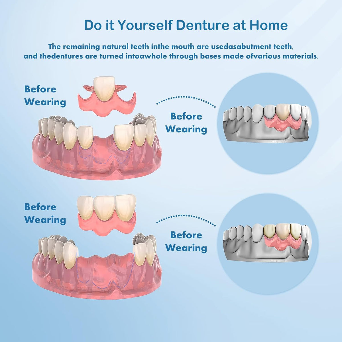 DIY Denture Complete Kit with Impression Material, Gum Material, Components for Top and Bottom Full or Partial Dentures Z531563